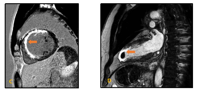 MRI scans of the heart,  showing a cross-sectional view and  a longitudinal section