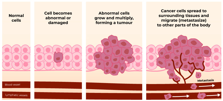 Diagram showing cancer cells spreading from the primary tumour to other body parts