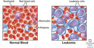 Normal Blood & Leukemia