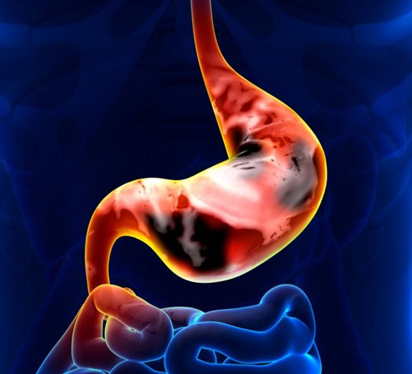 Does bacteria cause stomach cancer
