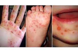 hand-foot-mouth disease hfmd