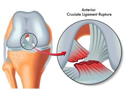 anterior cruciate ligament rupture