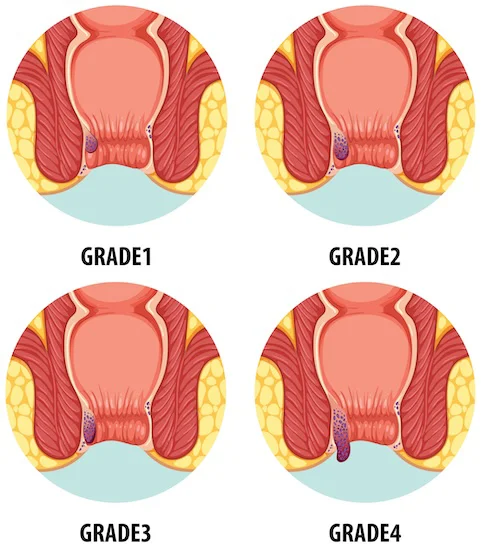 Internal haemorrhoids in different grades