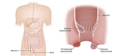 Types of haemorrhoids