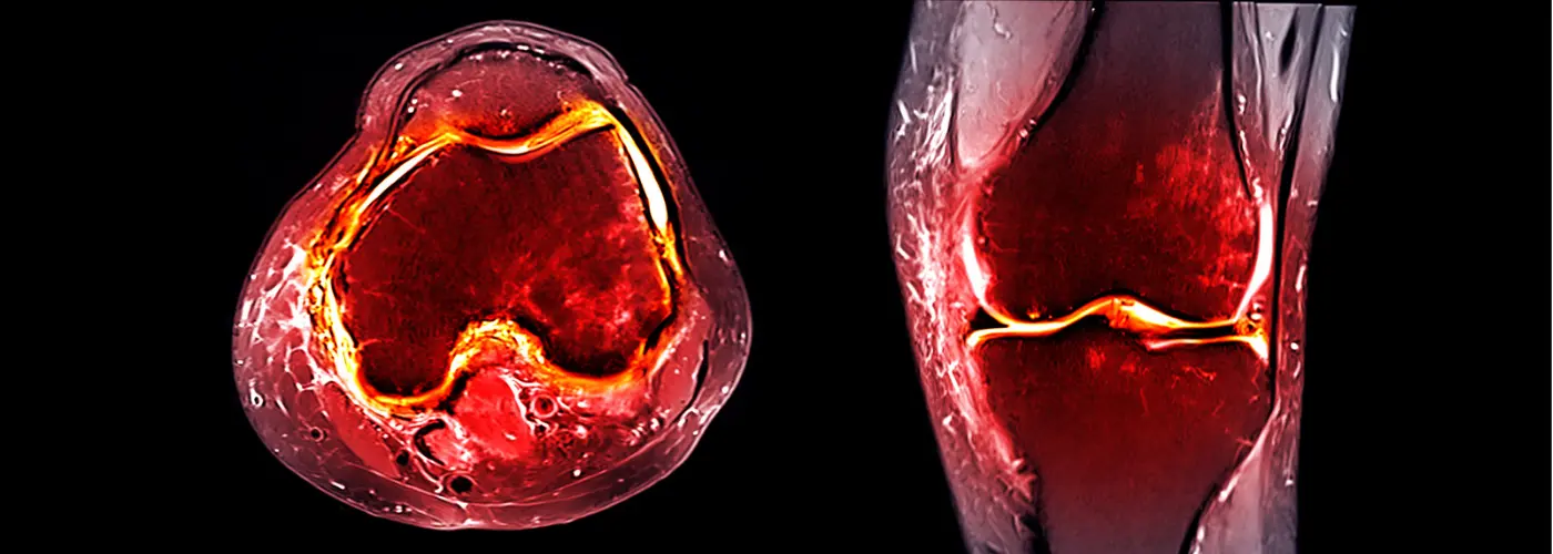 ACL vs TKR (1400px x 500px) image
