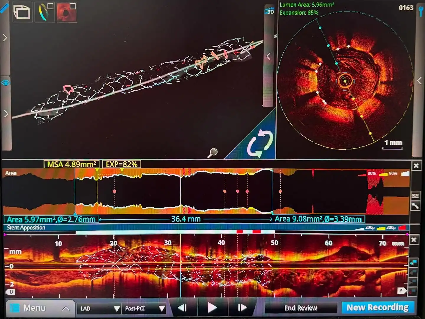 Advanced Angioplasty Technologies Article banner2