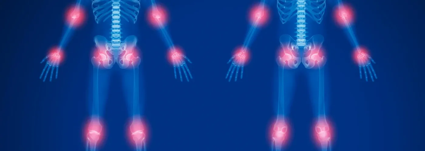 Arthritis vs Osteoporosis (1400px x 500px)