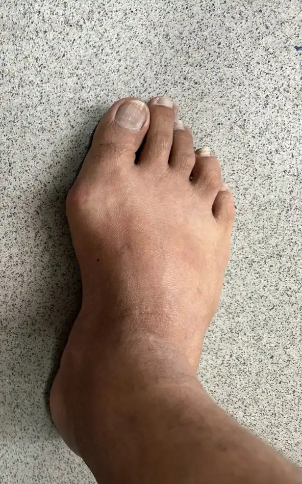 Bunions