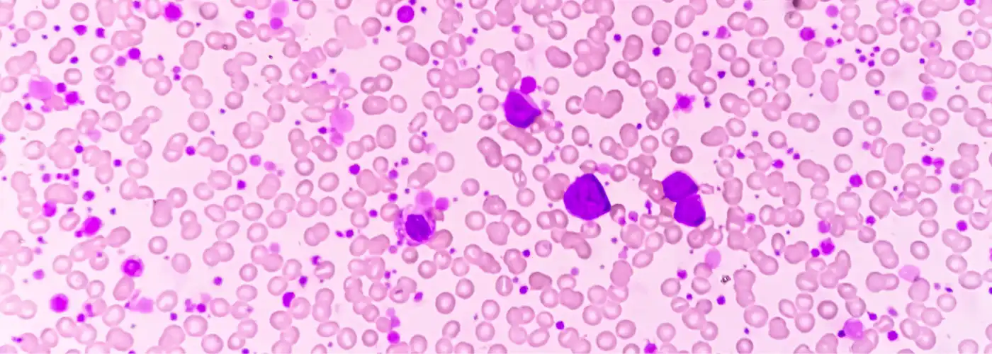 Chronic Myelogenous Leukemia (1400px x 500px)