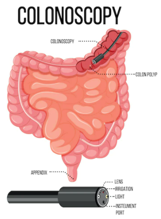 Colorectal Cancer