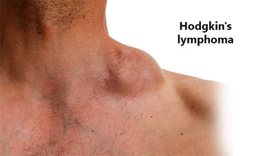 Hodgkin's Lymphoma