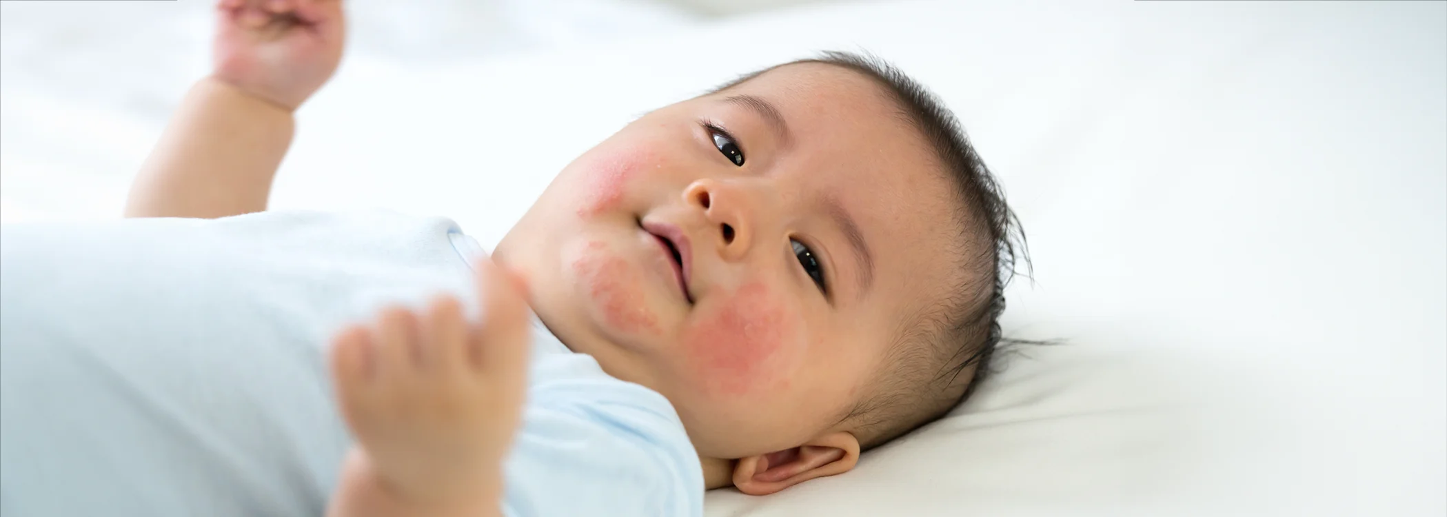 gleneagles-baby-eczema-copy