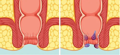 Haemorrhoids