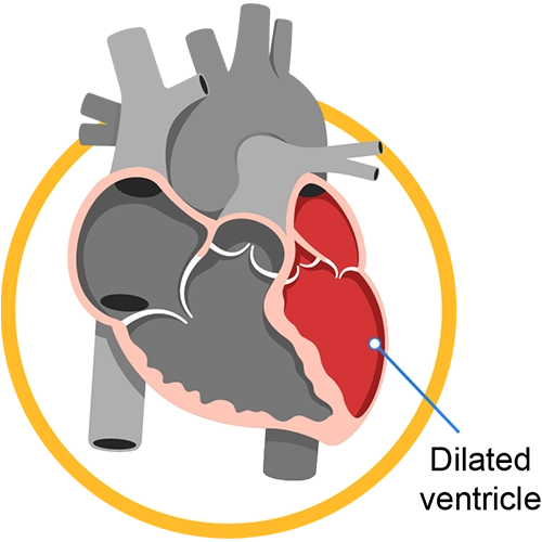 A heart highlighting a left ventricle