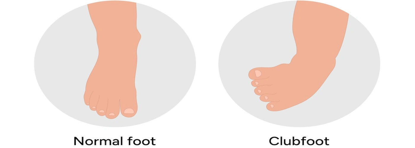 normal-vs-clubfoot