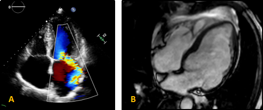 black and white MRI scan of the heart