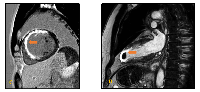 MRI scans of the heart, showing a cross-sectional view and a longitudinal section