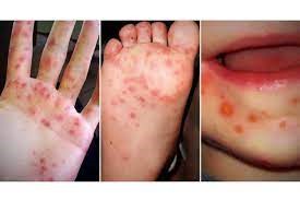 What All Parents Need to Know About Hand-Foot-Mouth Disease (HFMD) in Malaysia