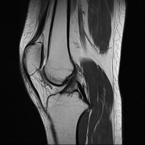 normal acl