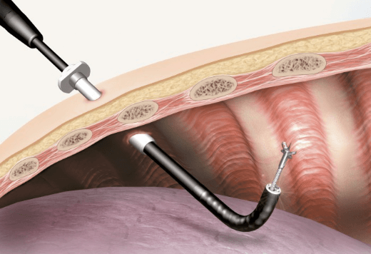 Pleuroscopy / Medical Thoracoscopy