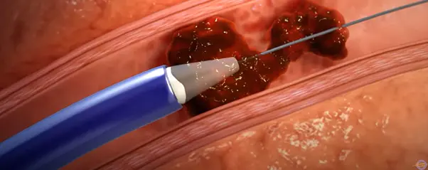 pulmonary-embolism-1