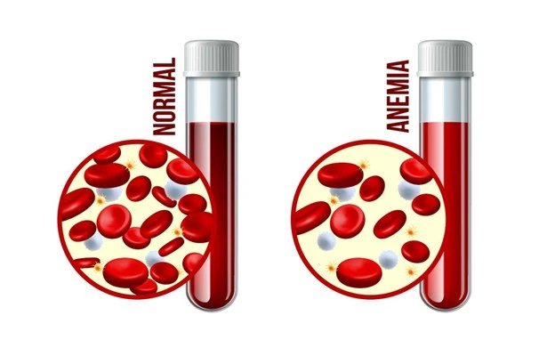 Understanding anaemia
